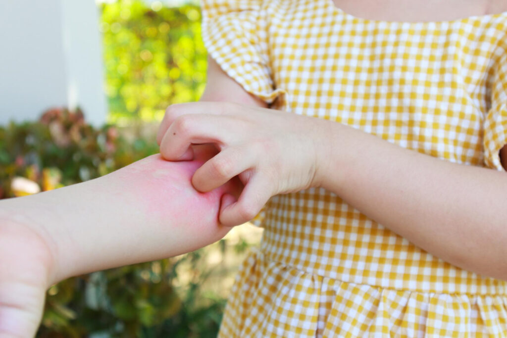 Chikungunya Pain Care​