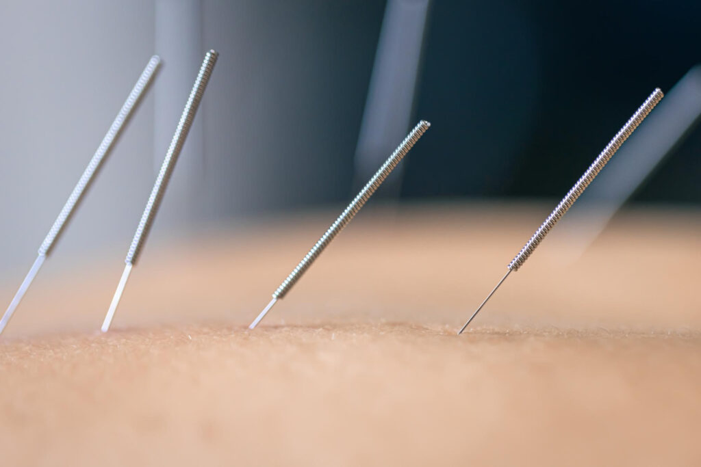 Medical Acupuncture